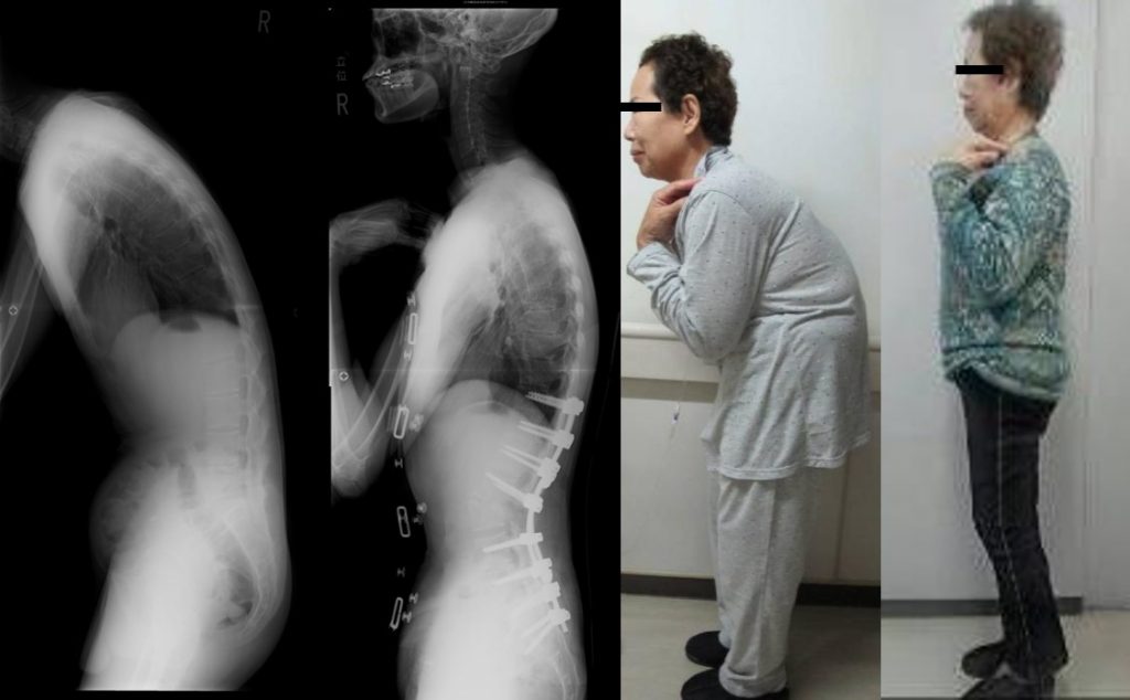 LDK の治療は保険またはメディケアでカバーされますか?