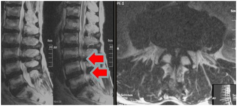 左：MRI矢状断麺　右：体軸断面　矢印部に狭窄を認める