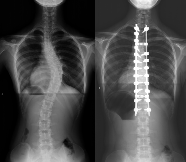 成人脊柱変形 （脊柱後弯症、後側弯症など）