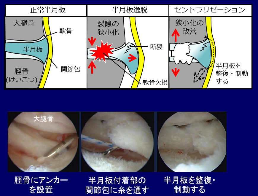 半月板損傷 東京医科歯科大学 整形外科