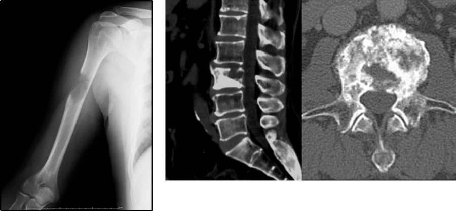 転移性RCCの治療