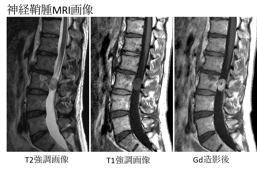 脊椎・脊髄腫瘍
