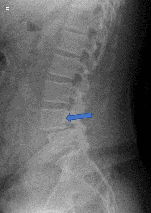 腰部脊柱管狭窄症　腰椎変性すべり症