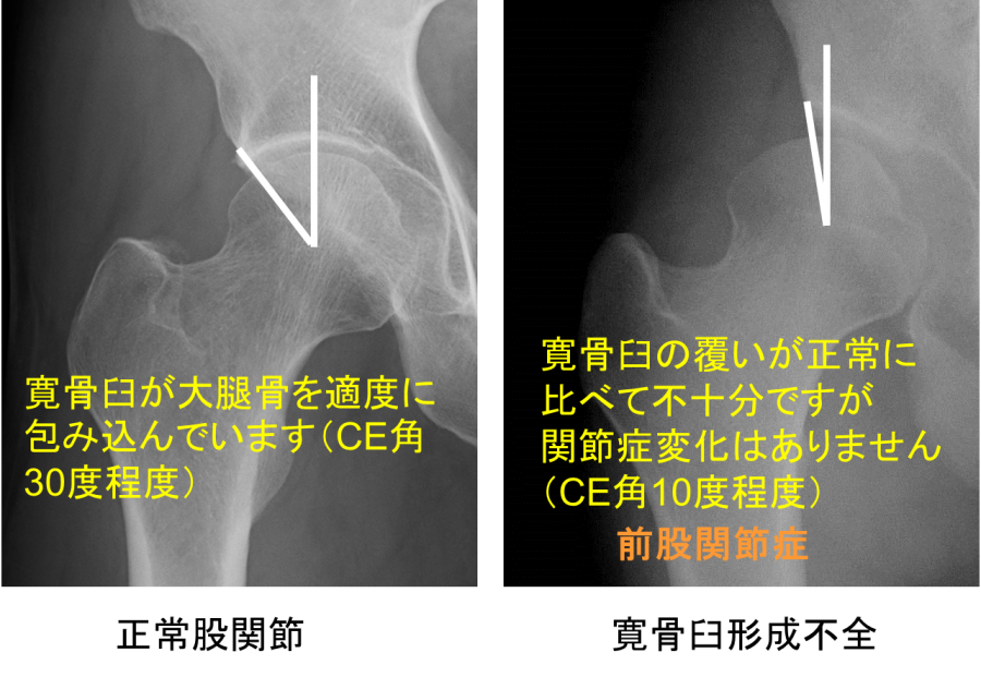 寛骨臼形成不全 - 東京医科歯科大学 整形外科