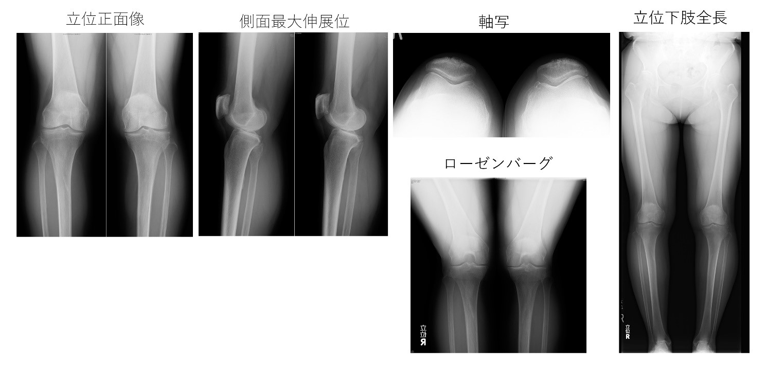 変形性 膝関節症 骨棘 _ 変形性膝関節症は治るのか – 骨にとげができてる?骨棘とは? – JFURY