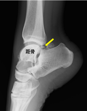 足関節後方インピンジメント症候群 三角骨障害など 東京医科歯科大学 整形外科