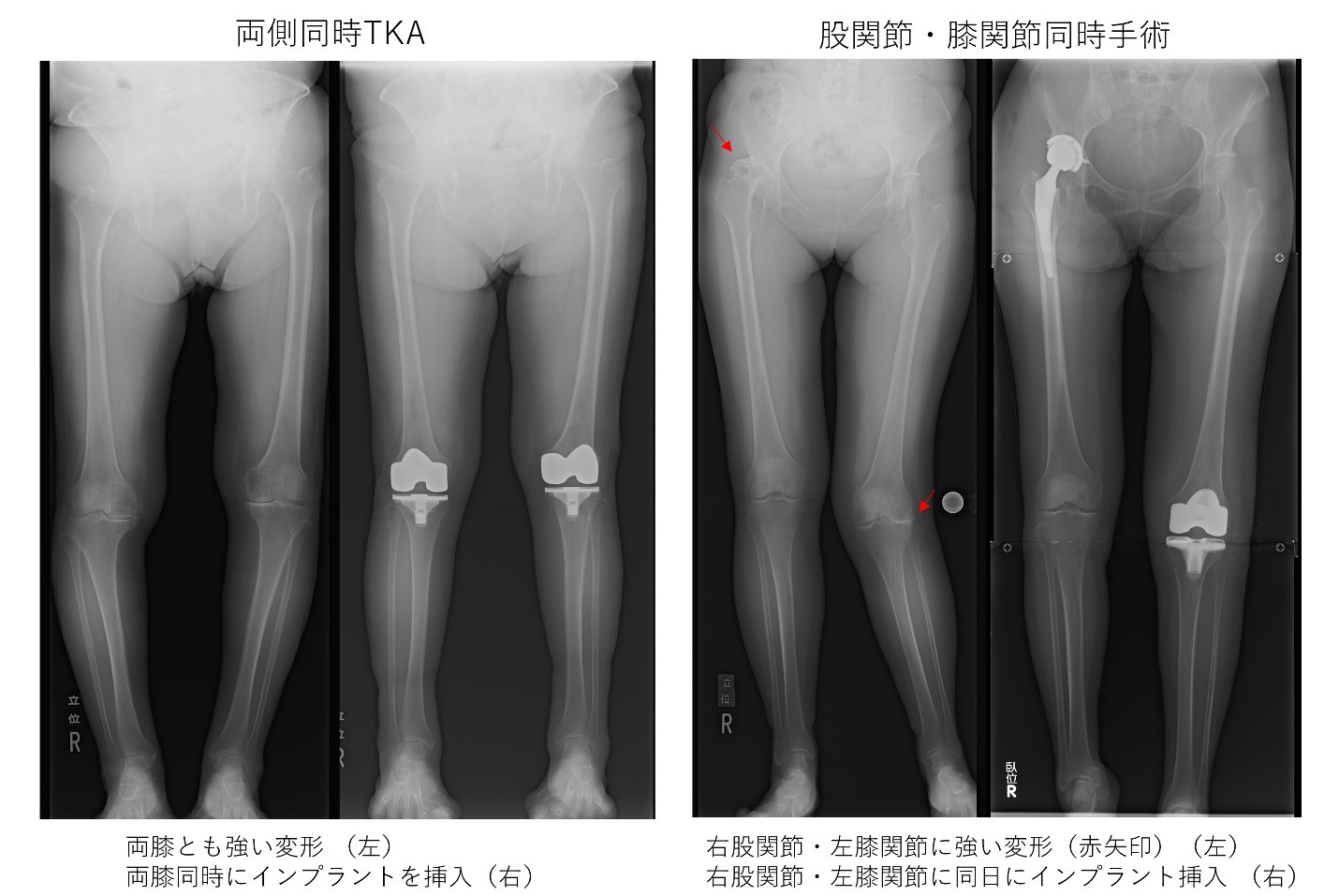変形性膝関節症手術入院期間, 変形性膝関節症 手術 入院期間 リハビリ – CJDJDC