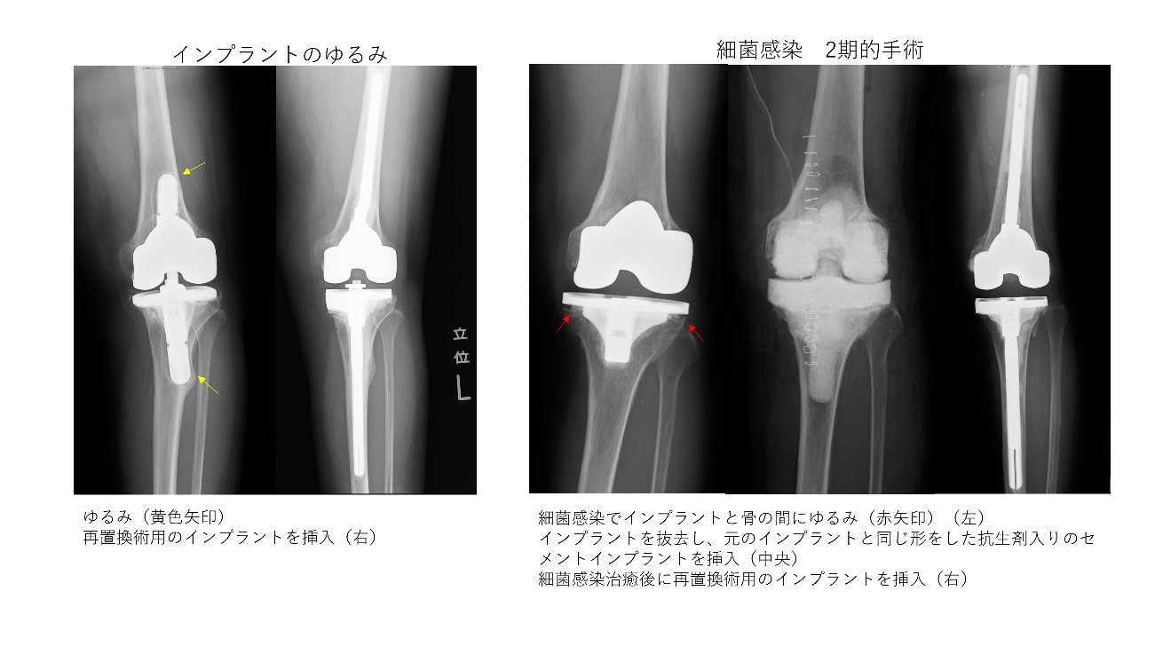 関節穿刺両膝算定 – 関節穿刺 検査 算定例 – QGDTMR