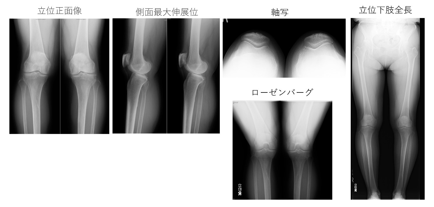 (日本語) 変形性膝関節症